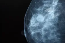 x-ray picture. Breast cancer